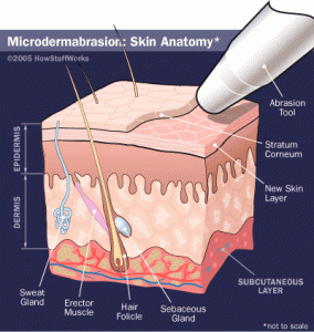 Micro Dermabrasion